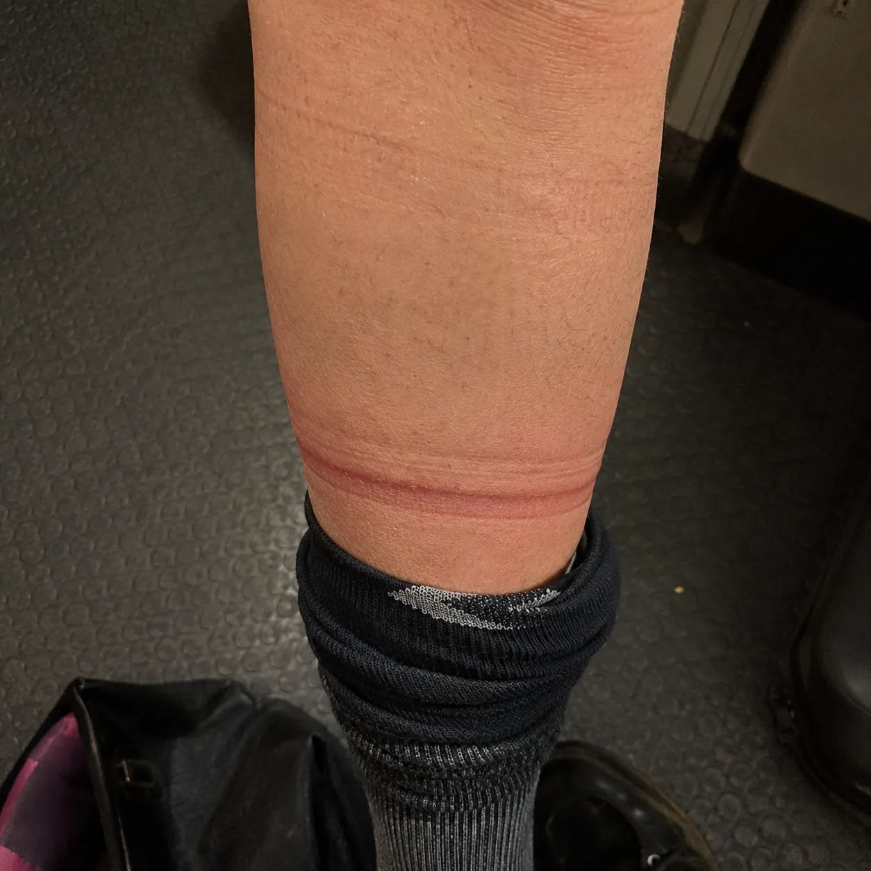 Compression-sock pressure ring pressed into a calf