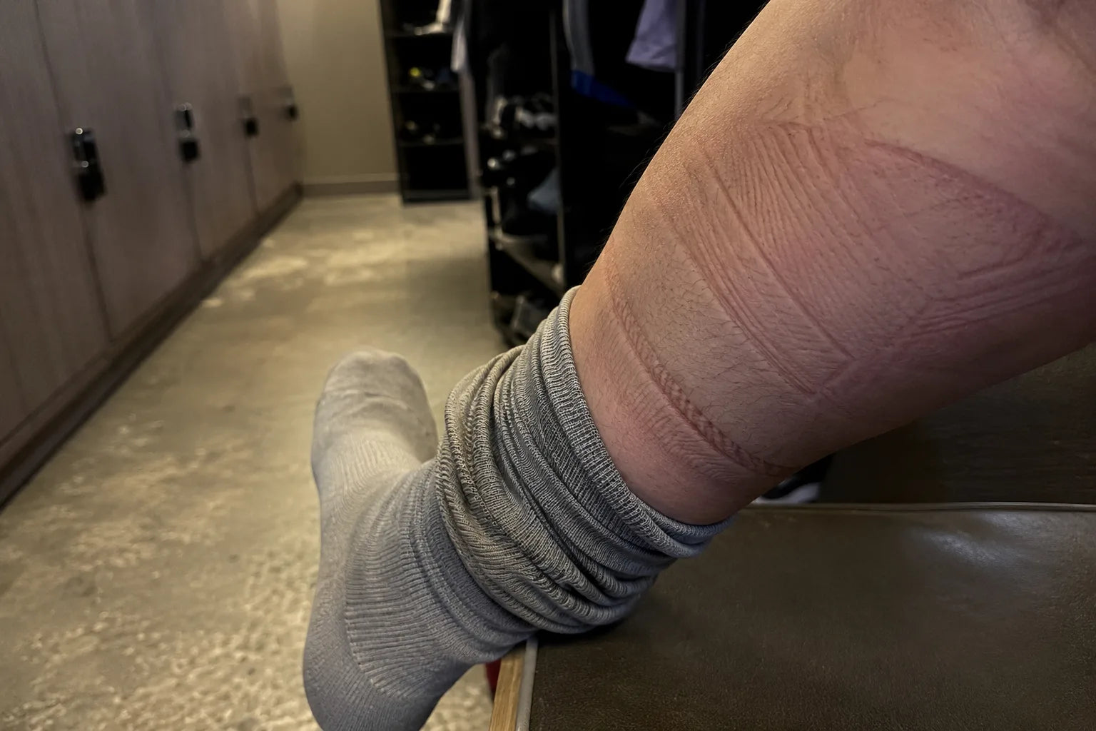 Deep red sock-dent grooves ringing a bare calf