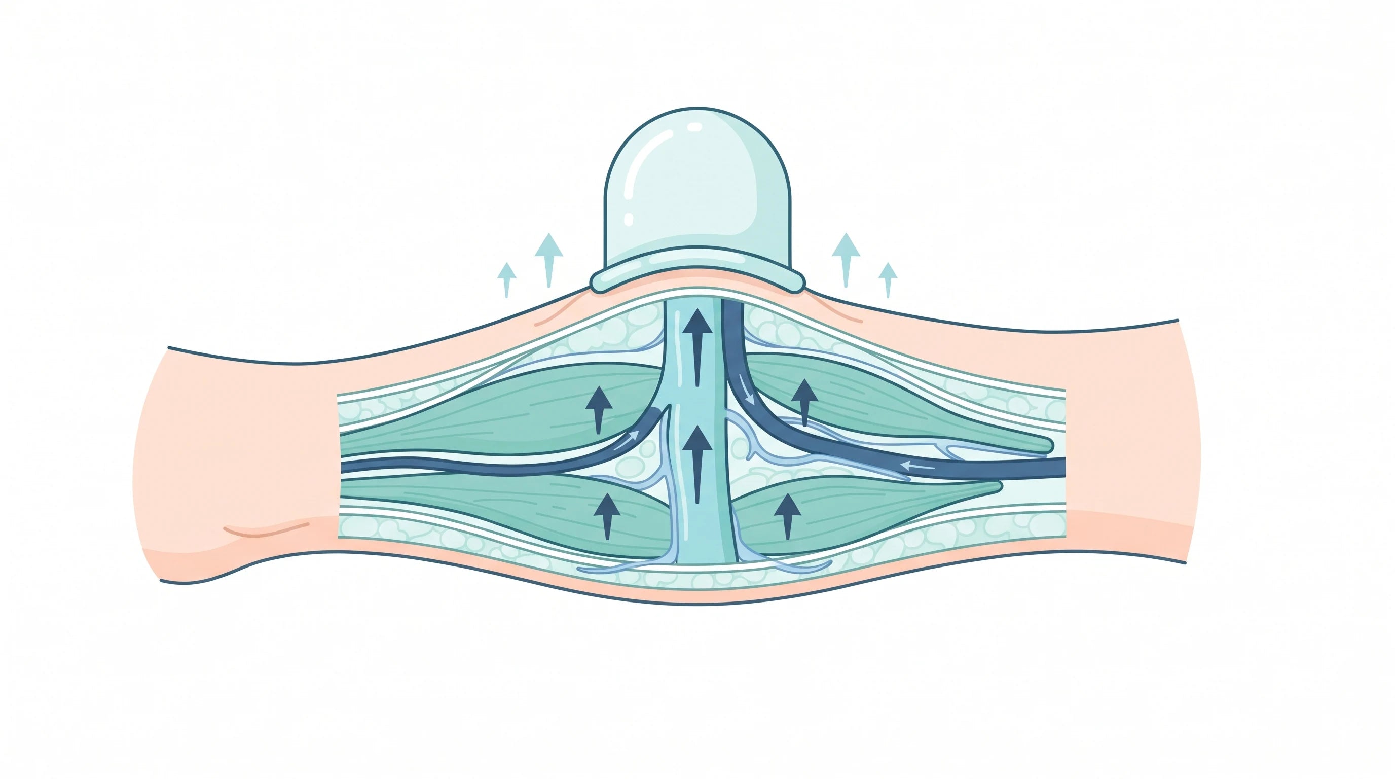 Cross-section of the calf showing gentle cupping suction lifting the tissue and drawing fluid upward